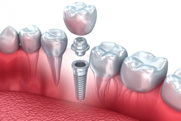 implantes-dentales-laboratorio-de-protesis-dental