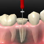 que-es-una-endodoncia