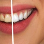 blanqueamiento dental