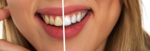 blanqueamiento dental