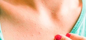 mujer mostrando parte superior del pecho donde se ven unos pequeños granos