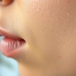 Bolitas de grasa en la cara: causas, prevención y tratamiento