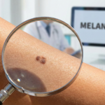 Melanoma: Lo que tu piel intenta decirte