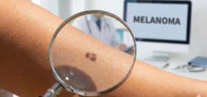 Melanoma Lo que tu piel intenta decirte. persona observando a traves de la lupa un lunar en su brazo