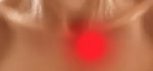 Primer plano de mucocele en el interior de la boca mostrando bulto en mucosa labial para diagnóstico dental.